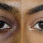 If you are troubled by dark circles under the eyes then these tips will give you relief.