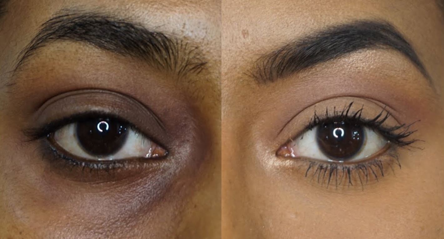 If you are troubled by dark circles under the eyes then these tips will give you relief.