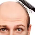 Are you worried about baldness? Do these 6 things daily, hair will start growing again