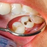 Do this if there is a worm in your teeth, know these home remedies for teeth cavity