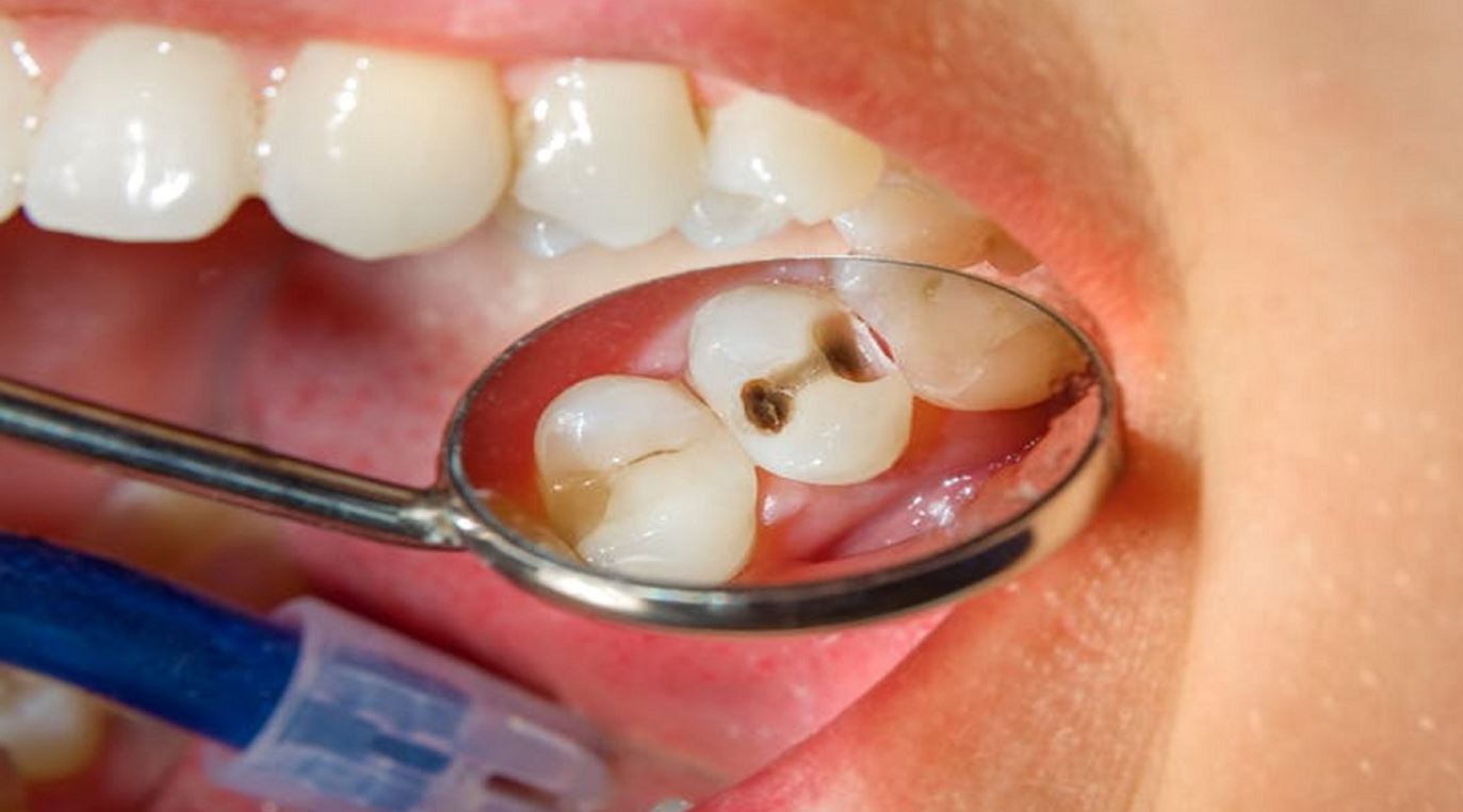 Do this if there is a worm in your teeth, know these home remedies for teeth cavity