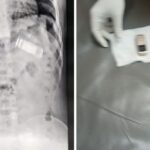 Prisoner swallowed mobile phone in Central Jail, SMS hospital doctors took him out without operation