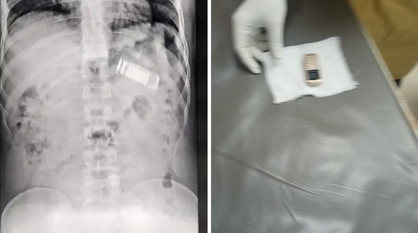 Prisoner swallowed mobile phone in Central Jail, SMS hospital doctors took him out without operation