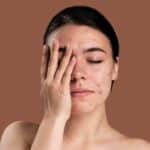 Are you troubled by the problem of pimples on your face during the rainy season? Follow these tips