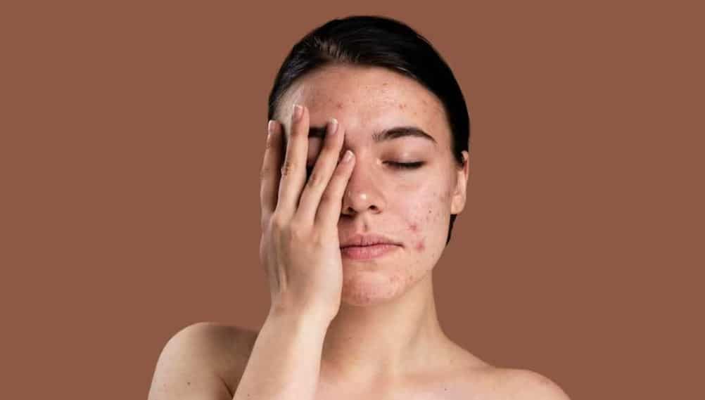 Are you troubled by the problem of pimples on your face during the rainy season? Follow these tips