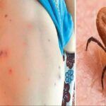 Increasing threat of scrub typhus in Rajasthan, a challenge for the health department